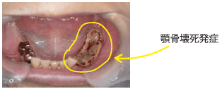ではなぜ歯科治療をうける際に、歯科医師に伝える必要があるのでしょうか。それは、ビスホスホネート製剤を使用した経験がある方は、歯科治療を契機に顎骨壊死が発生することが近年問題になっているからです。顎骨壊死は、歯肉の痛み、腫れ、ぐらつき、あごのしびれ、骨がむき出しになる、顎の骨が腐るなどの症状があります。