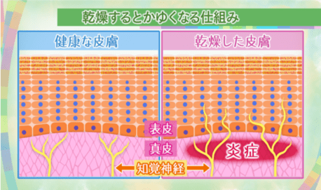 大きく2つの理由が考えられます。1つ目は、乾燥すると皮膚の内部で軽い炎症が起きているということです。目には見えない(赤い炎症などがない)程度に炎症が発生しています。2つ目は、かゆみを伝える知覚神経が本来は、真皮の内側でとどまっていますが、乾燥肌になると皮膚の表面近くまで伸びてくるため、日常生活のわずかな刺激でもかゆみを感じるようになるからです。